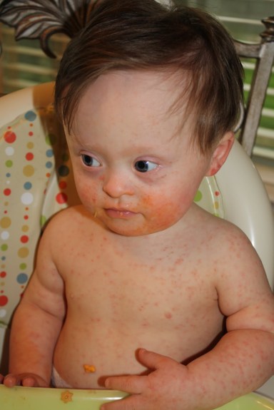 Reaction to Measles, Mumps & Rubella Vaccine -- the boy also had undiagnosed Parvo (dog's virus/parasite)